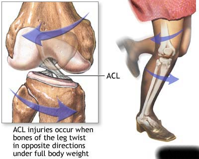 Frequent ACL injuries sideline athletes, cause frustration